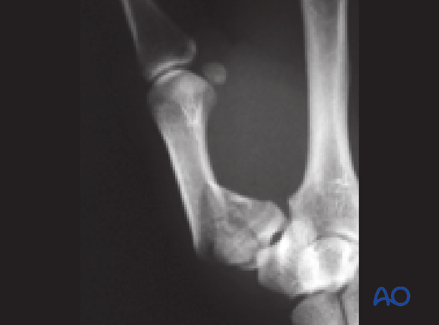 If the fracture can not be reduced anatomically, open reduction and internal fixation must be performed.