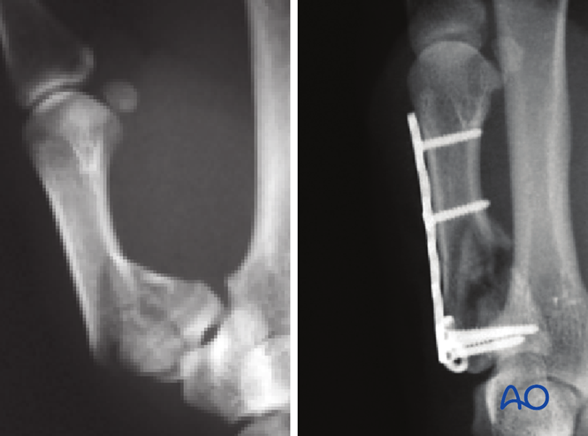 Plate fixation for Metacarpal, Rolando fracture