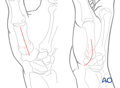 Metacarpal, Rolando fracture