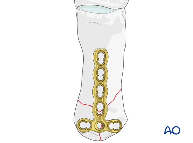 A T-shaped plate is best suited for these fractures.