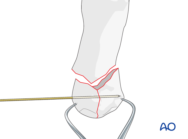 Preliminarily fix the articular fragments of the base of the thumb with a pointed reduction forceps.