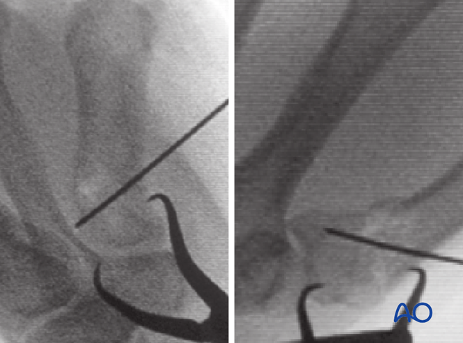 Plate fixation for Metacarpal, Rolando fracture