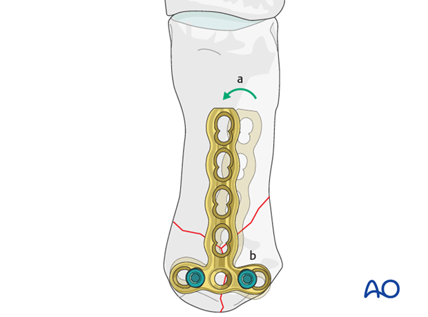 Align the plate along the shaft. Insert a second locking head screw into the other articular fragment.