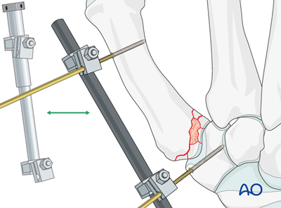 External fixation for Metacarpal, base