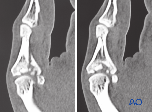 It is difficult to assess the extent of articular comminution from plain radiographs. A CT scan is advisable.