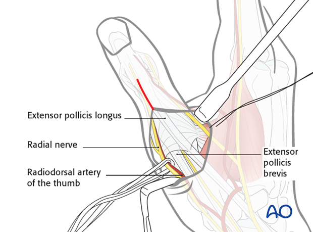 Be careful not to detach the insertion of the extensor pollicis brevis (EPB) into one of the basal fragments.