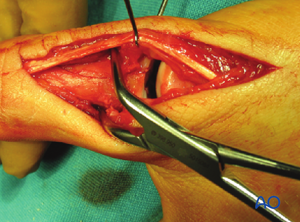 Use a pointed reduction forceps to reduce and hold the diaphyseal fragments.