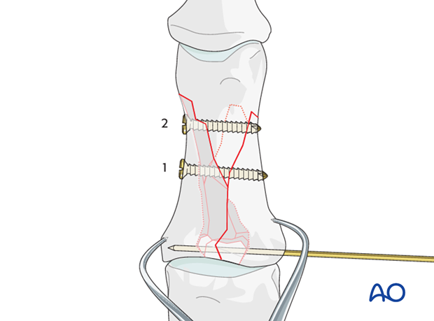Repeat the above procedure for a second lag screw to be inserted into the distal part of the diaphysis.