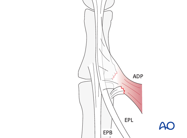 Ulnar collateral ligament injuries are also named skier’s, or gamekeeper’s, thumb. If undiagnosed it leads to chronic ...
