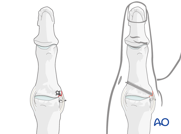 Two alternative techniques are available for collateral ligament reattachment: suture anchors, or tunneling.