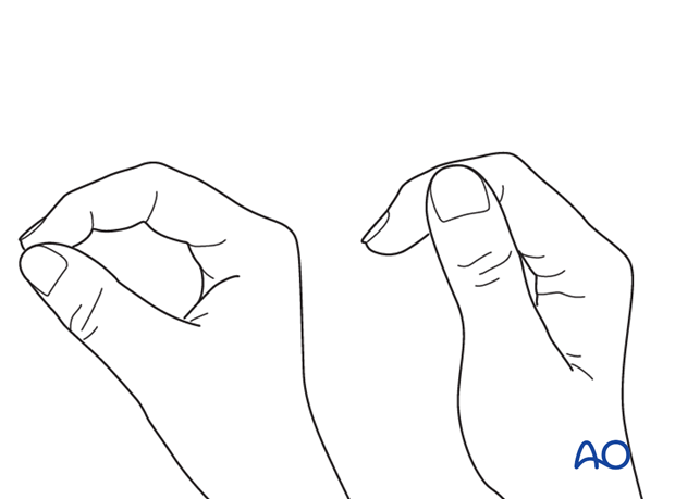 Correct rotation of the thumb can be difficult to judge. Make sure that the tip of the thumb correctly reaches the tip of ...