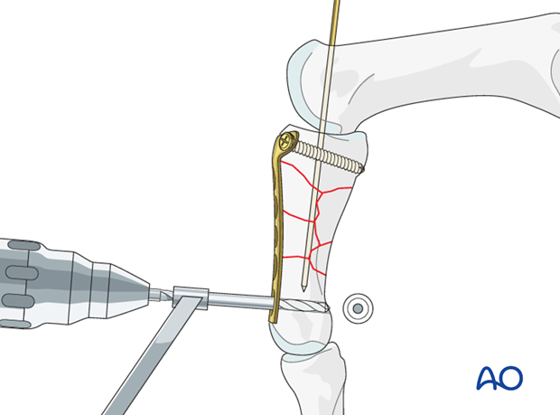 Partially withdraw the provisional K-wire, sufficiently to prevent interference with drilling the most distal hole. 