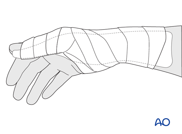 In noncompliant patients, a more restrictive well-padded thumb spica cast may be a wiser choice.