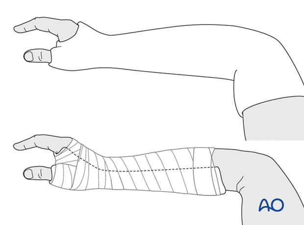 Immobilize the wrist in a well-padded below-elbow plaster with the wrist slightly extended, and the thumb immobilized in a ...