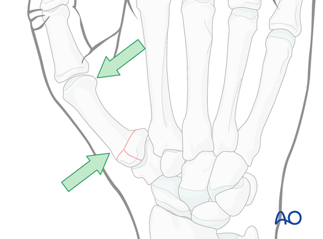 Nonoperative treatment for Metacarpal, Rolando fracture