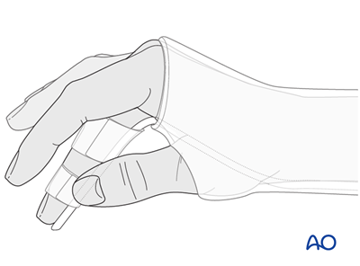 Nonoperative treatment for Proximal phalanx, articular (head), oblique