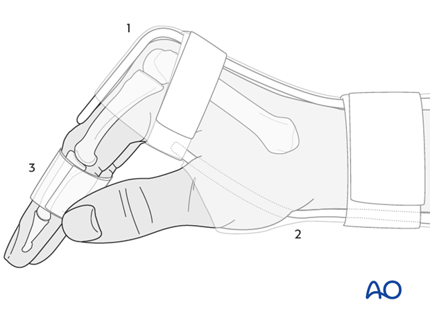 This technique allows immediate mobilization of the interphalangeal joints of all fingers.