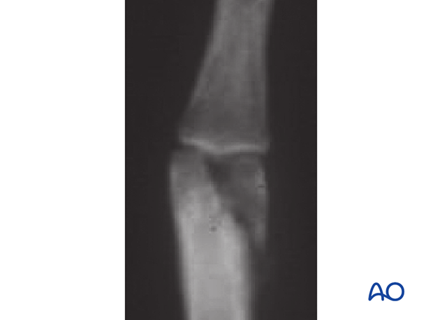 This x-ray shows a true unicondylar fracture, the ideal indication for this approach.