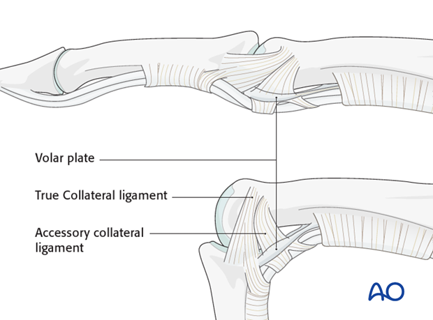 The primary structures stabilizing the interphalangeal joints and preventing displacement in the coronal plane ...