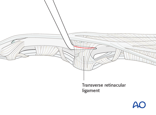 In order to avoid accidentally cutting the collateral ligament, insert a dental pick between it and the TRL.