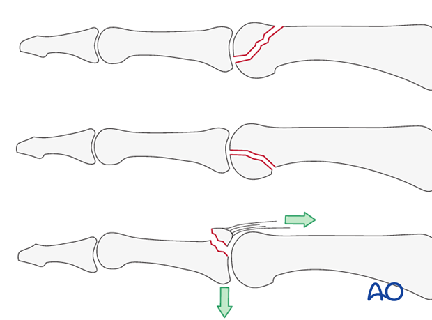 The dorsal approach to the proximal interphalangeal (PIP) joint is indicated for intraarticular fractures. It is also useful ...