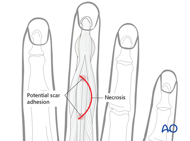 Alternatively, make a curved skin incision over the PIP joint. The convexity of the incision is planned so that the scar ...