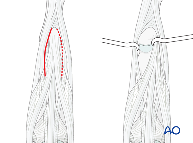Make an incision in the tendon, between the central slip and the lateral band.