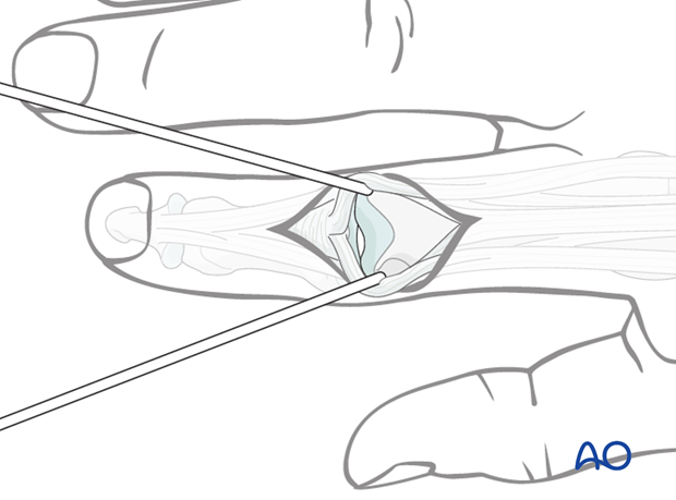 Make a straight incision and perform a longitudinal midline tenotomy. Do not disinsert the central slip.