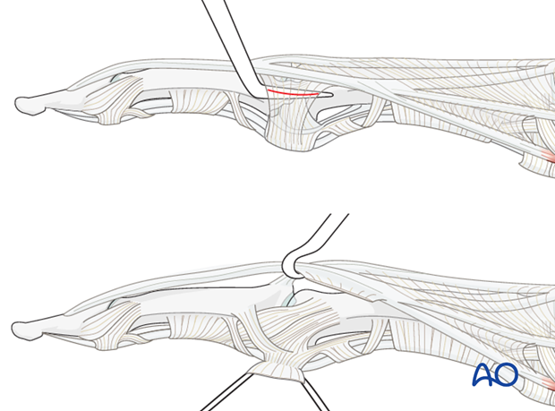 Incise gently lateral to the lateral band. Divide the TRL, using a dental pick inserted between it and the collateral ...