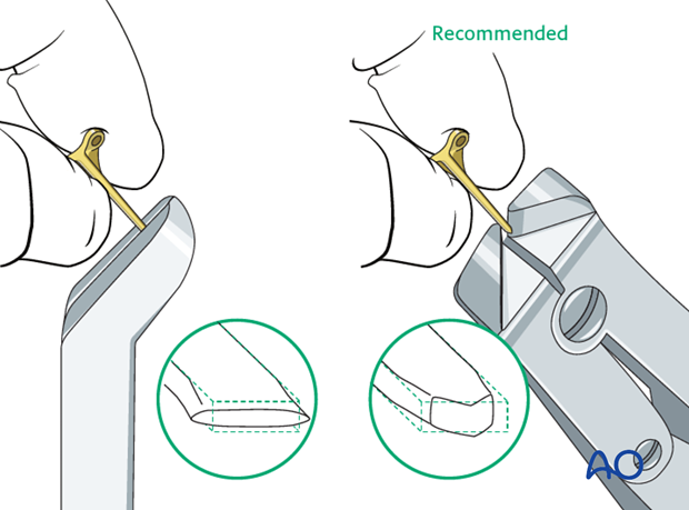 Metaphyseal simple oblique fracture of proximal phalanx – Minicondylar compression plate fixation 