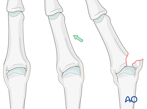 Avulsion fracture of proximal phalanx MCP joint – Tension-band wiring