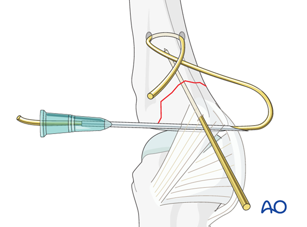 Avulsion fracture of proximal phalanx MCP joint – Tension-band wiring