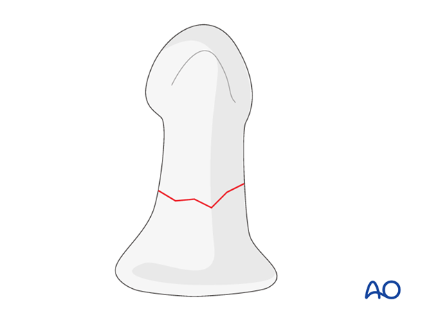 Transverse fractures of the proximal half of the distal phalanx are not well-suited to nonoperative treatment when there is no d