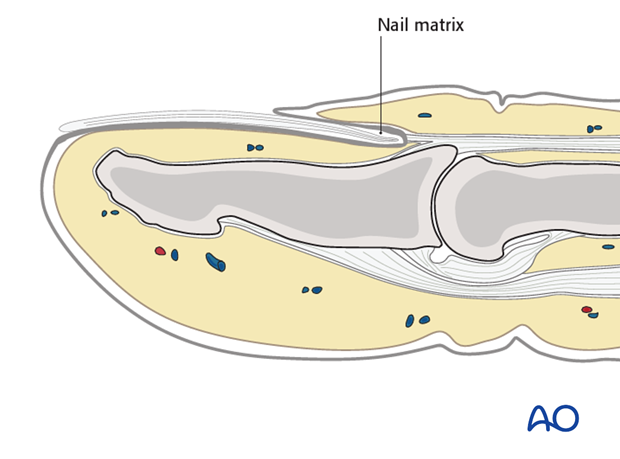 Damage to the nail matrix must be avoided, since it may cause permanent deformity of the nail.