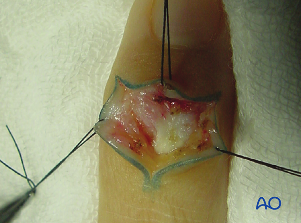 Depending on the shape of the skin incision, flaps should be elevated and held with fine sutures to minimize soft-tissue trauma.