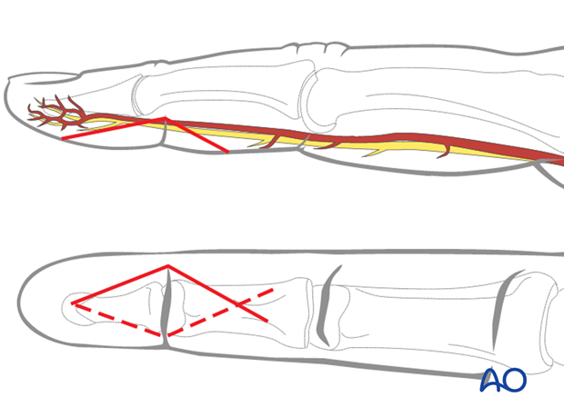 Make a carefully planned palmar angled skin incision (Bruner zigzag), using the flexor skin crease as a guide, as illustrated. 
