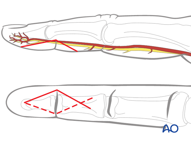 k wire fixation