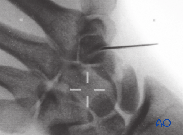 Screening the scaphoid with an image intensifier