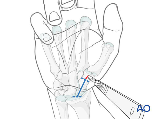 72_A010_i050 Making a stab incision during minimally invasive palmar approach to the scaphoid