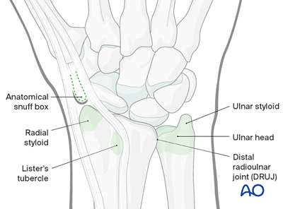 Combined approach to perilunate fractures and dislocations