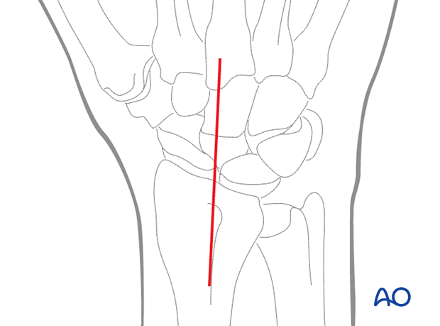 Dorsal approach to the wrist