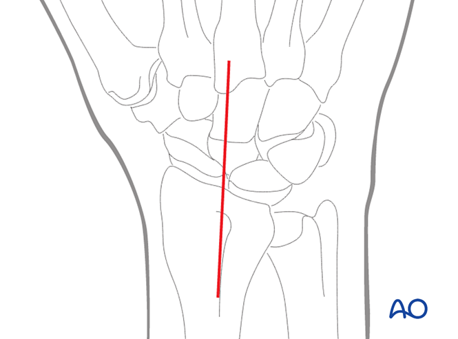 ORIF - Scapholunate reduction and ligament repair for Lunocapitate and ...