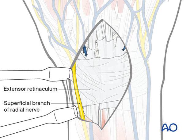 Elevation of the skin flap of a dorsal approach to the wrist