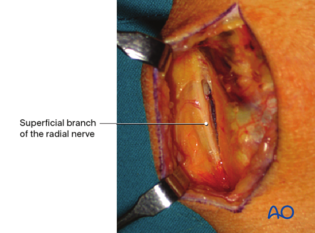 Intraoperative image showing the superficial dorsal branch of the radial nerve