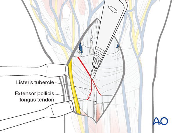 Opening the 3rd extensor compartment in a dorsal approach to the wrist