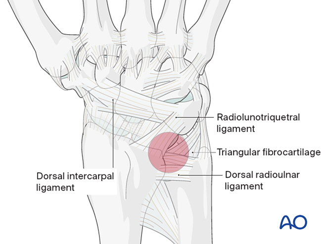 Combined approach to perilunate fractures and dislocations