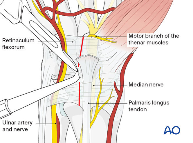 Combined approach to perilunate fractures and dislocations