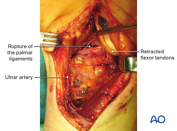 Intraoperative image showing a rupture of the palmar ligaments