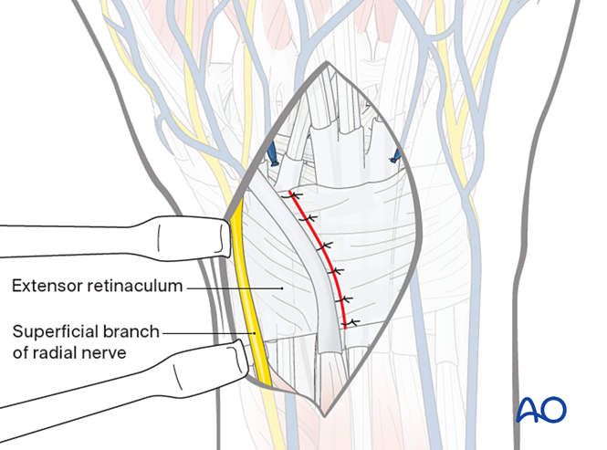 Combined approach to perilunate fractures and dislocations