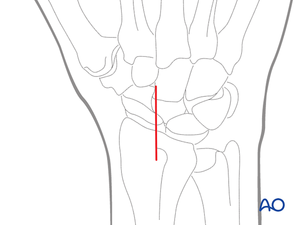 A straight dorsal skin incision, starting over Lister’s tubercle, and extending distally for about 3–4 cm.